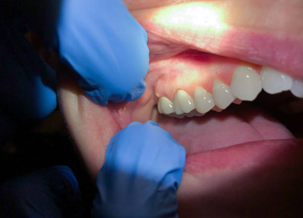Best Dentist for Tooth Abscess  in Roslyn Estates, NY